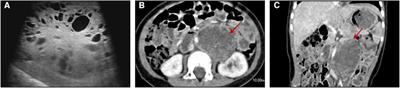 Rare pediatric synchronous bilateral testicular germ cell tumors of different pathological types: a case report